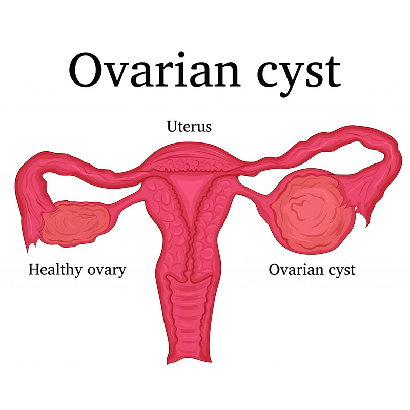 ovarian cyst