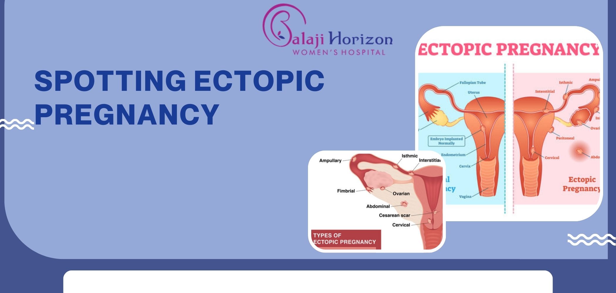 ectopic pregnancy