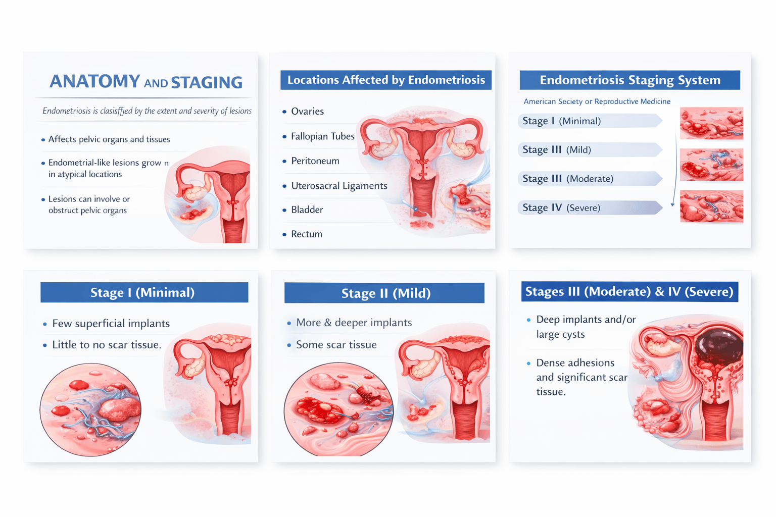 Endometriosis anatomy and rASRM staging illustration