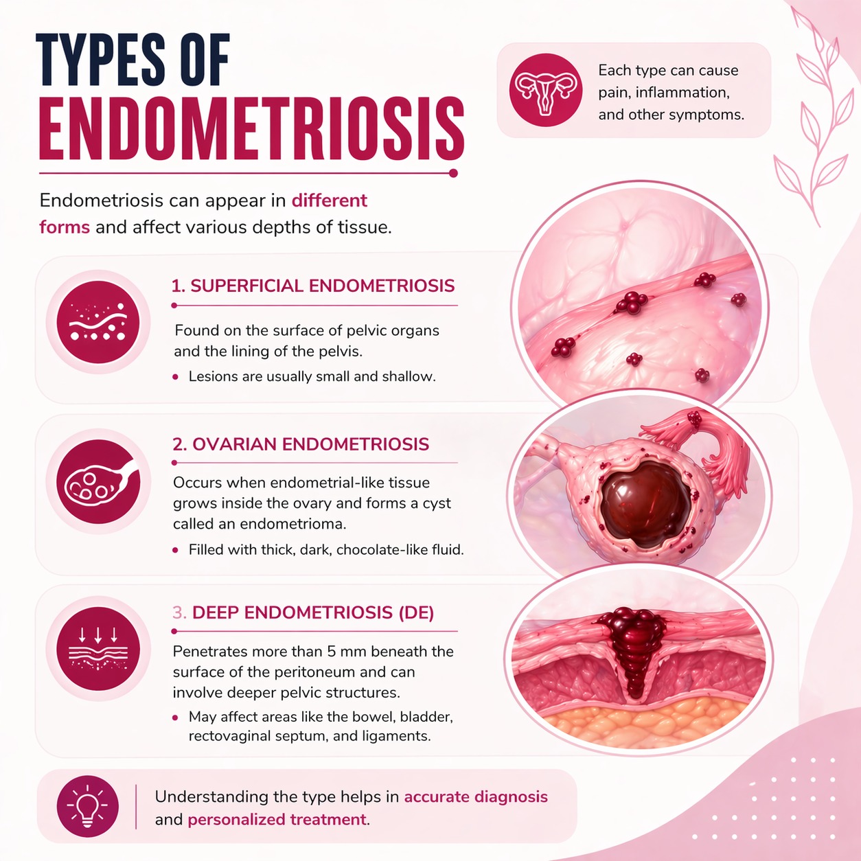 Diagram showing different types of endometriosis including DIE and Chocolate Cysts by Dr. Priyadatt Patel.