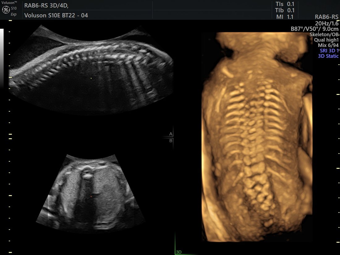 3D skeletal survey of the fetal thorax, GE Voluson S10