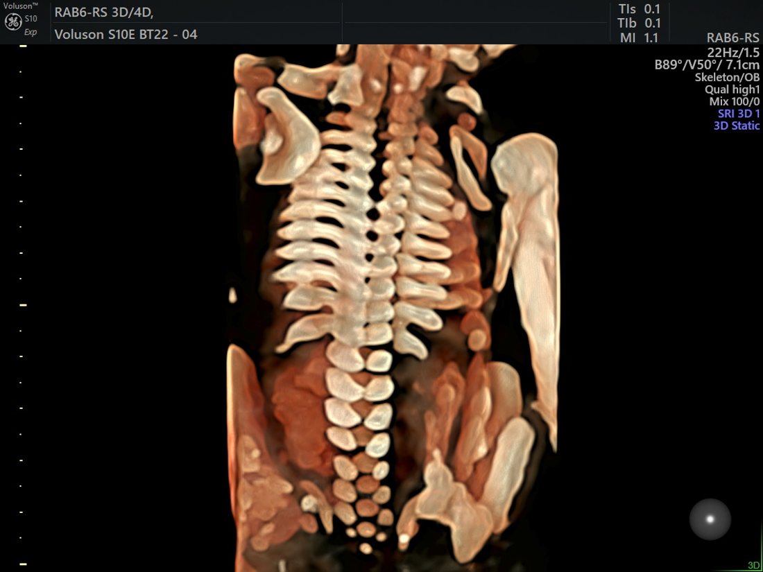 3D fetal spine survey on the anomaly scan, GE Voluson S10