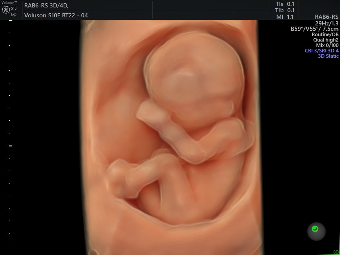 3D view of the whole baby, GE Voluson S10 Expert