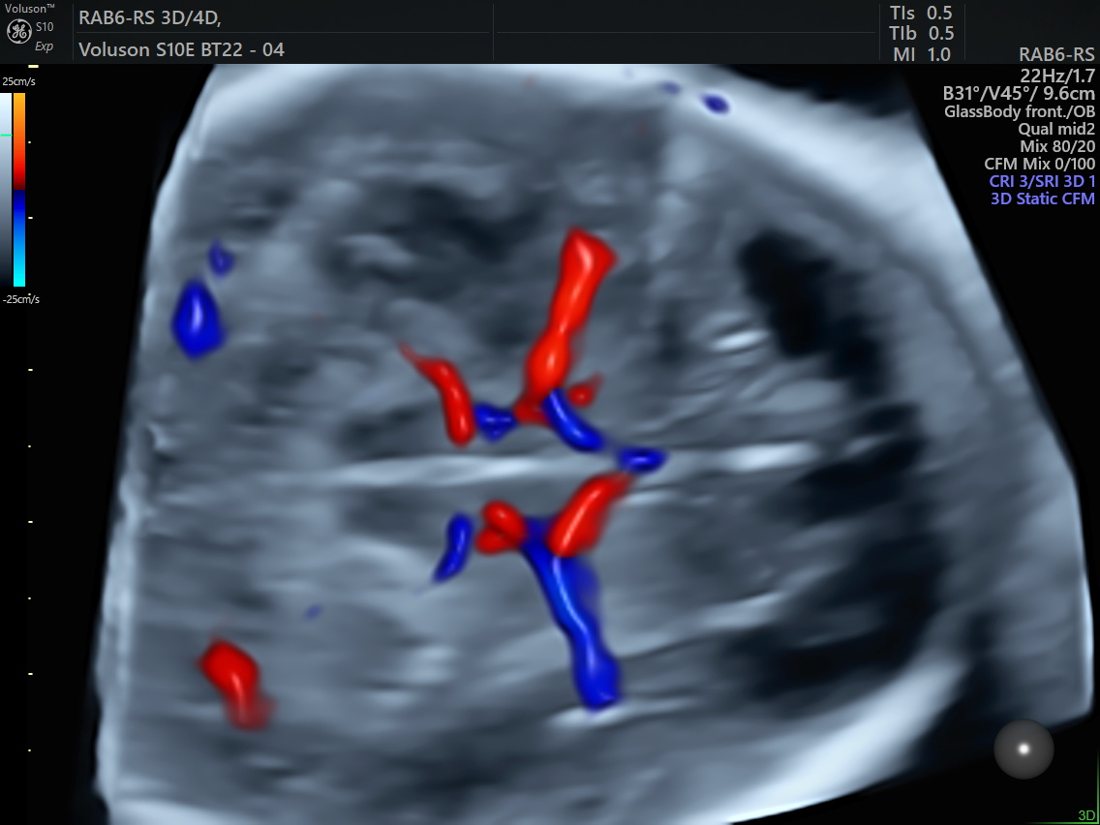 3D GlassBody colour-flow vascular imaging on the GE Voluson S10 Expert
