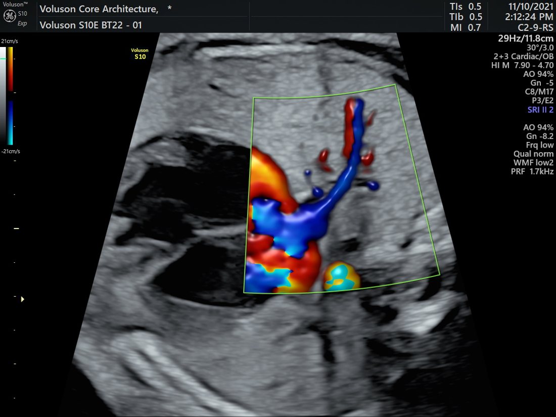 Colour Doppler flow mapping of fetal vessels, GE Voluson S10