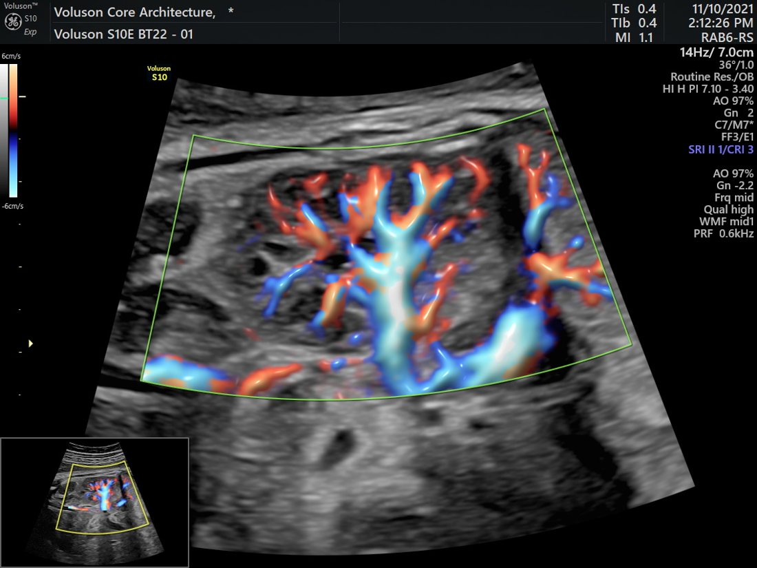 Colour Doppler of fetal cranial vessels, GE Voluson S10