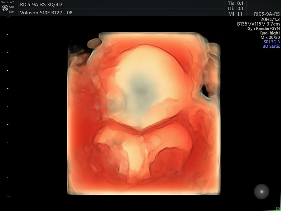 Early gestational sac in 3D, GE Voluson S10