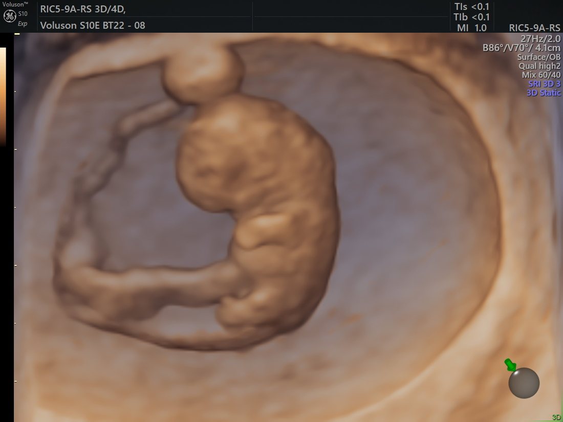 HDlive early-pregnancy fetus, GE Voluson S10