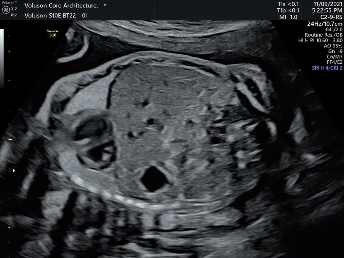 Growth Scan & Fetal Biometry in Ahmedabad | Balaji Horizon 1 2D fetal abdomen, GE Voluson S10