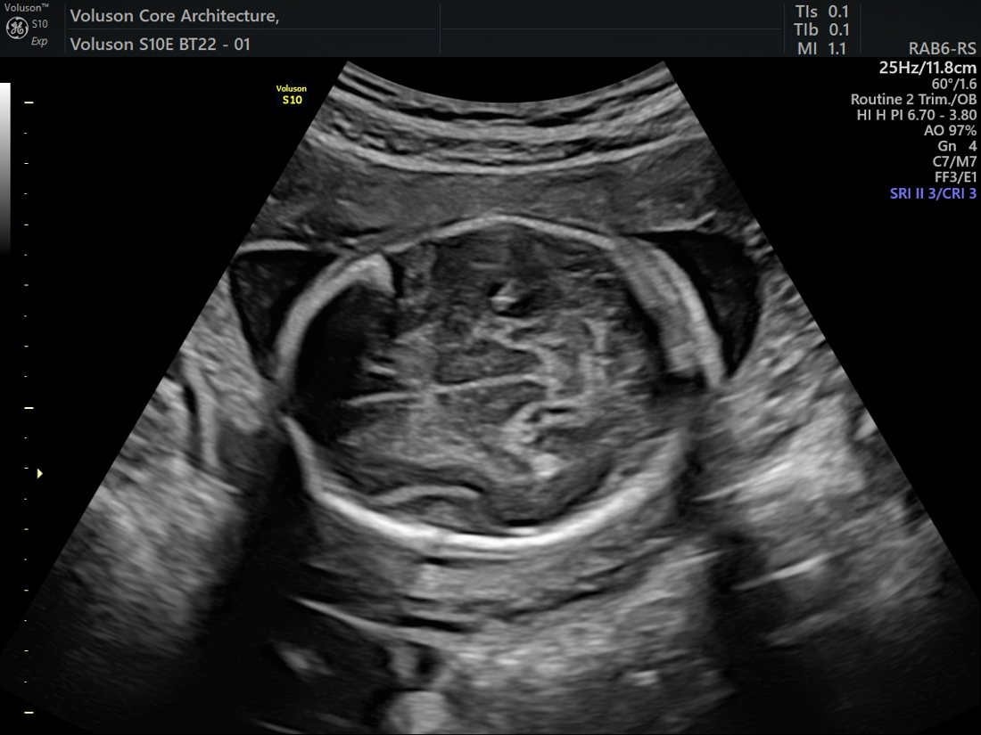 Growth Scan & Fetal Biometry in Ahmedabad | Balaji Horizon 2 Fetal head biometry plane, GE Voluson S10