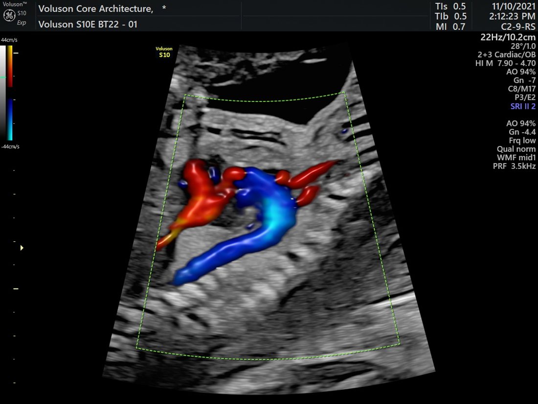 Fetal Echocardiography in Ahmedabad | Balaji Horizon 2 Colour Doppler of the fetal heart, GE Voluson S10