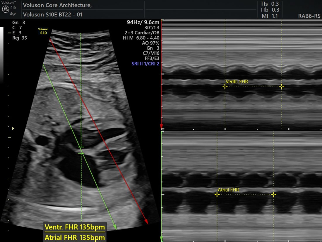 Fetal Echocardiography in Ahmedabad | Balaji Horizon 3 M-mode fetal heart rate and rhythm, GE Voluson S10