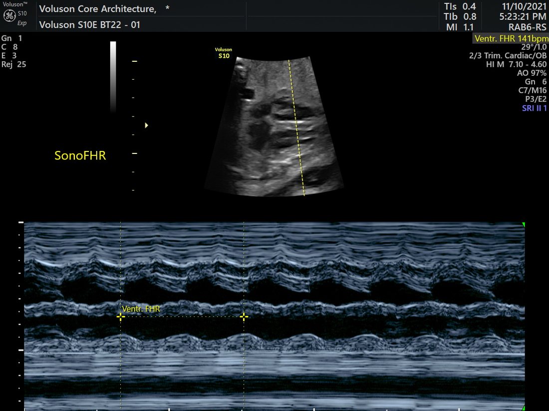 Fetal Echocardiography in Ahmedabad | Balaji Horizon 4 Fetal heart rate SonoFHR, GE Voluson S10