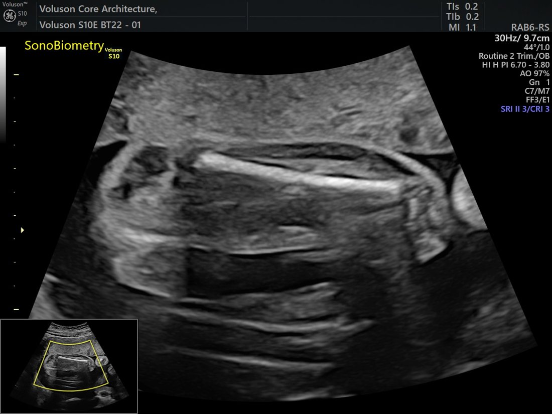 Growth Scan & Fetal Biometry in Ahmedabad | Balaji Horizon 3 Automated fetal biometry SonoBiometry, GE Voluson S10