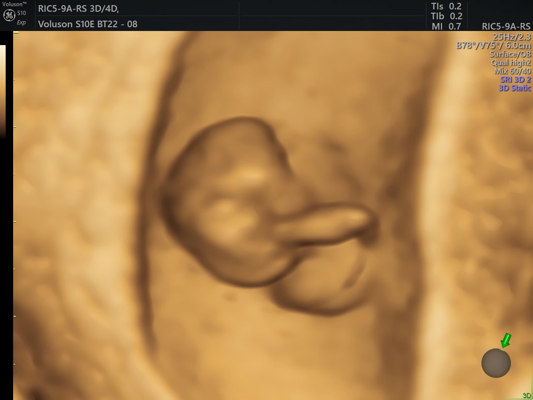 First-trimester fetus in 3D, GE Voluson S10