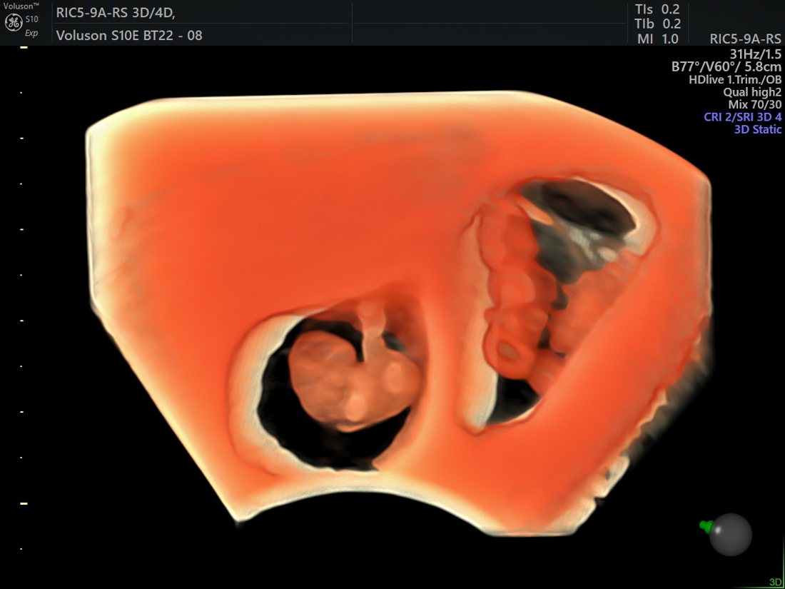 Gestational sac and embryo, GE Voluson S10