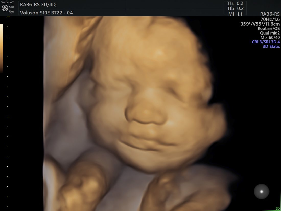 HDlive 3D fetal face on the GE Voluson S10 Expert