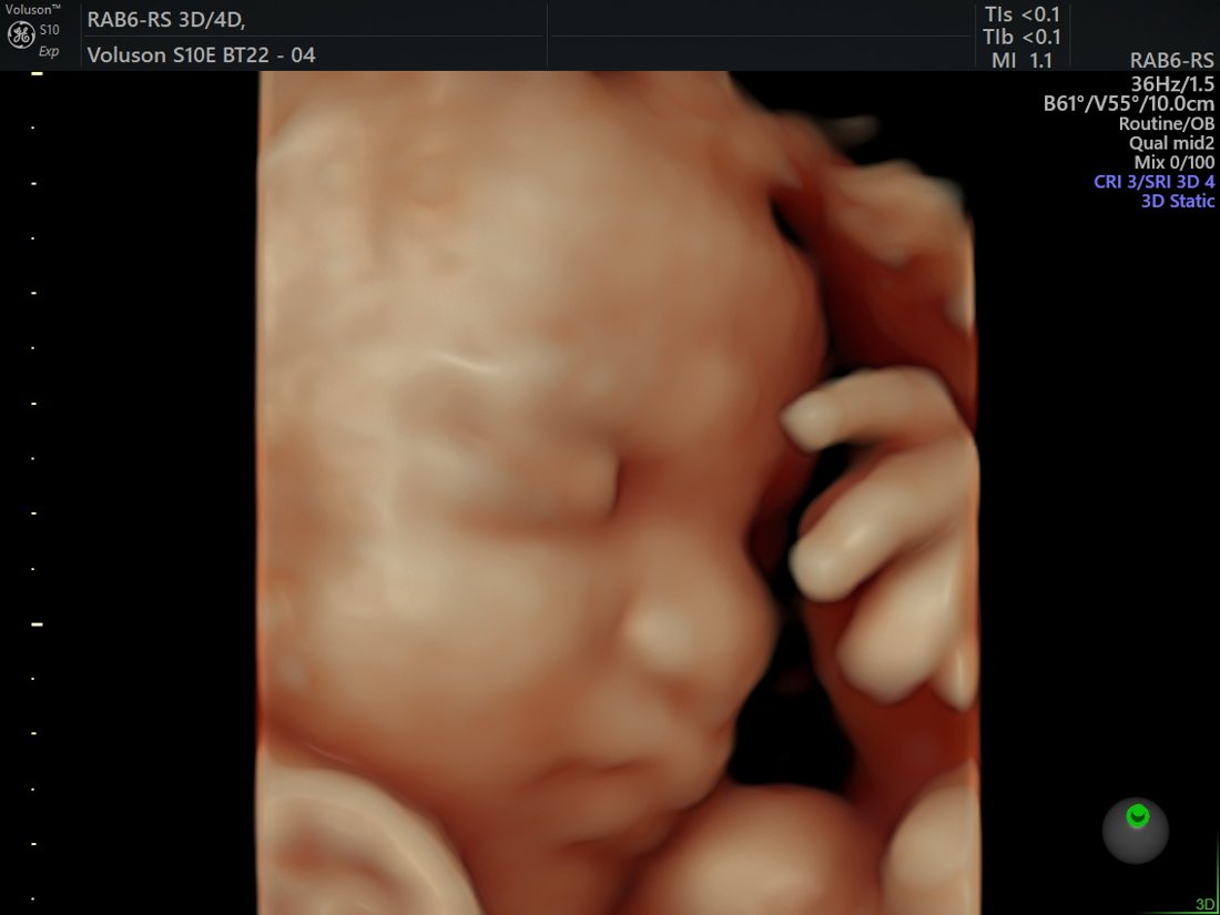 HDlive 3D fetal face in profile, GE Voluson S10 Expert