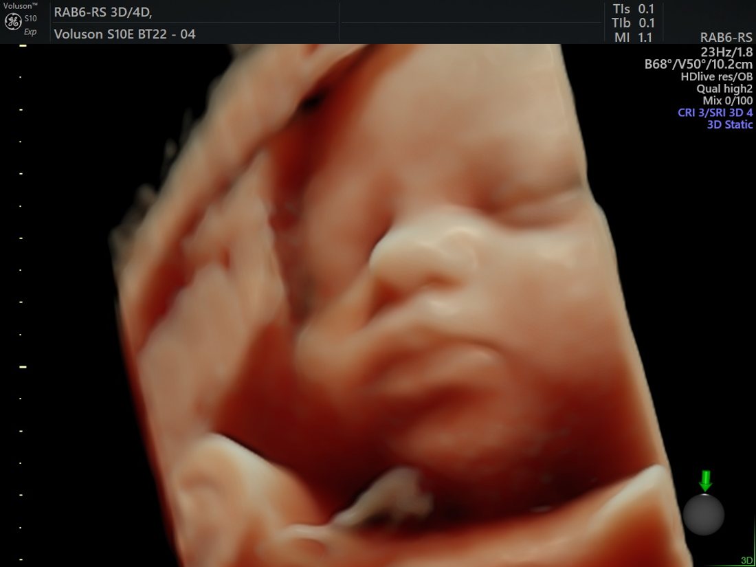 HDlive 3D fetal portrait, GE Voluson S10 Expert