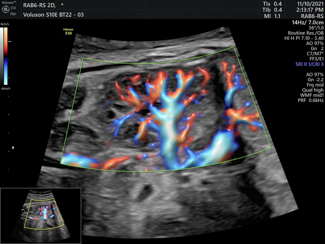 Colour Doppler of placental circulation, GE Voluson S10