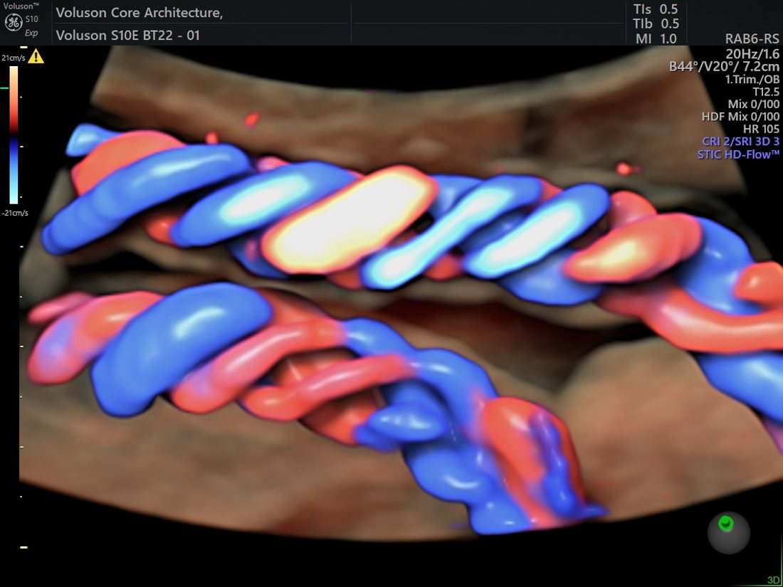 Radiantflow 3D imaging of the umbilical cord, GE Voluson S10