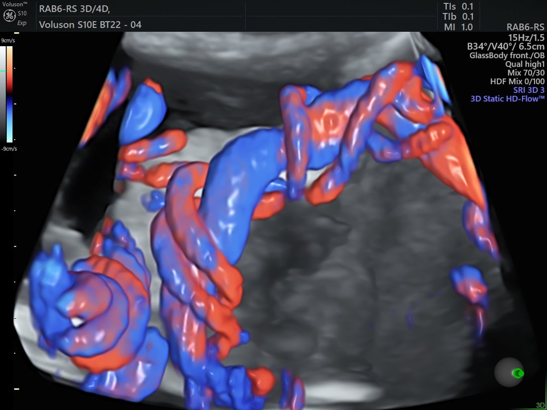 Radiantflow imaging of umbilical cord and placental flow, GE Voluson S10