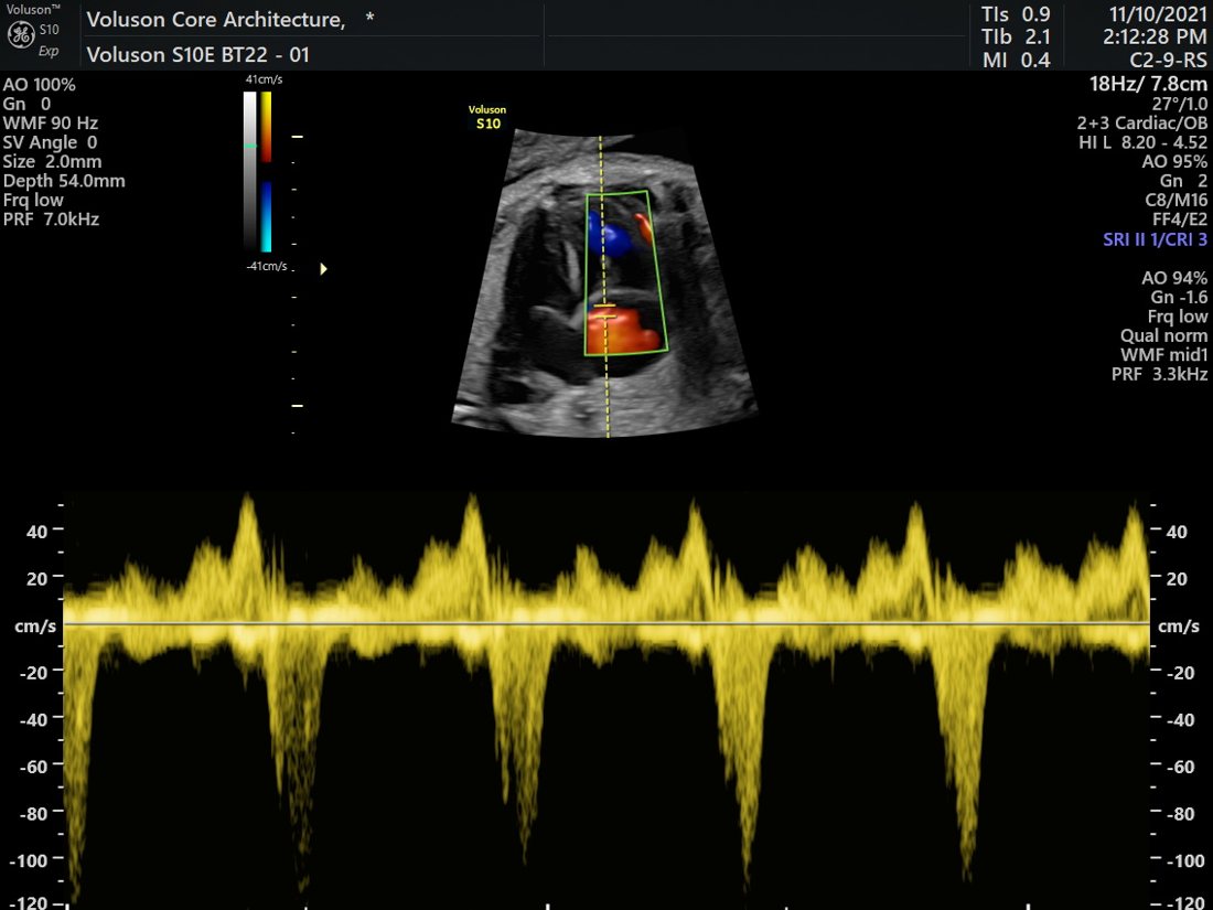 Umbilical artery Doppler waveform on the GE Voluson S10 Expert