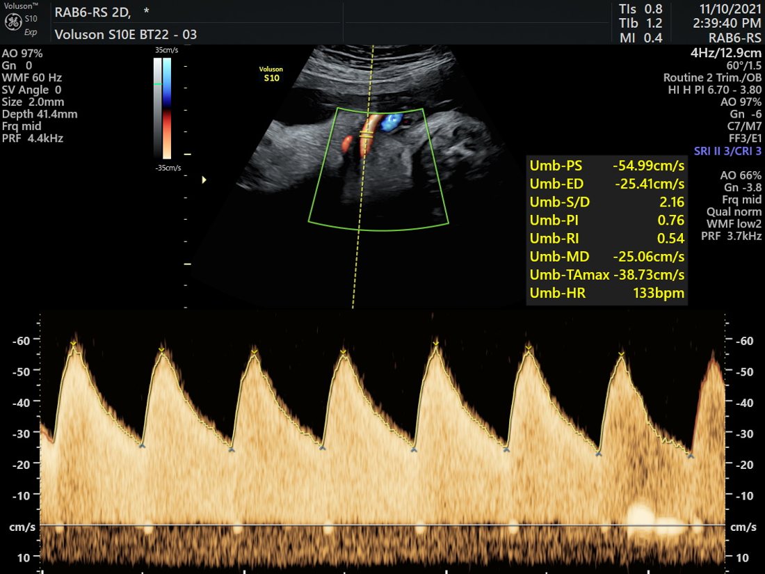 Umbilical artery Doppler waveform, GE Voluson S10