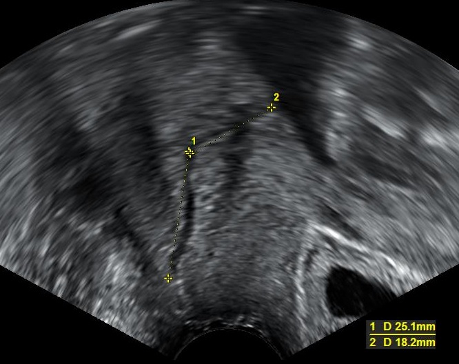 Transvaginal ultrasound cervical length measurement (illustrative example)